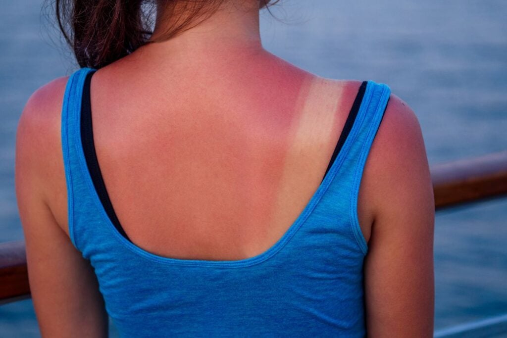 womans sun burn skin 